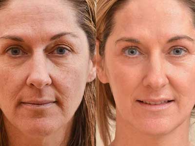 Foto Lavoro prima e dopo laser resurfacing